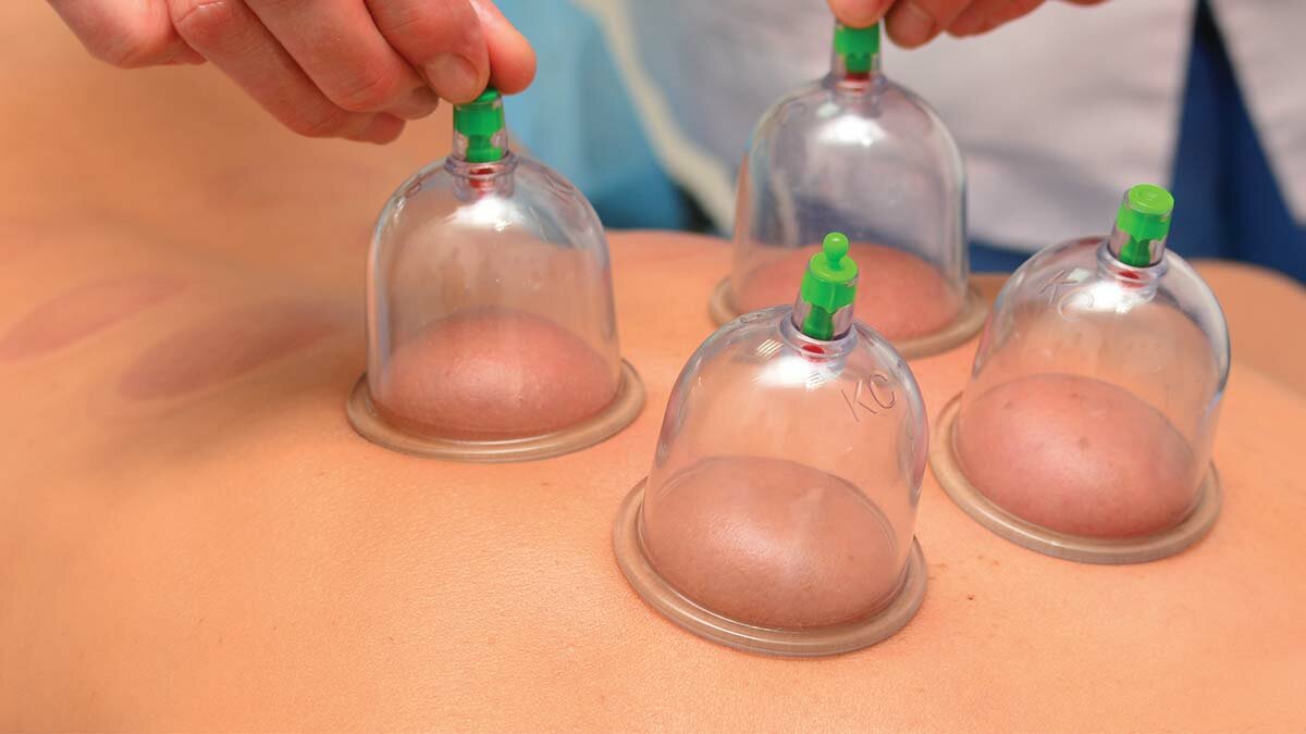 Formation VENTOUSES, CUPPING THERAPY